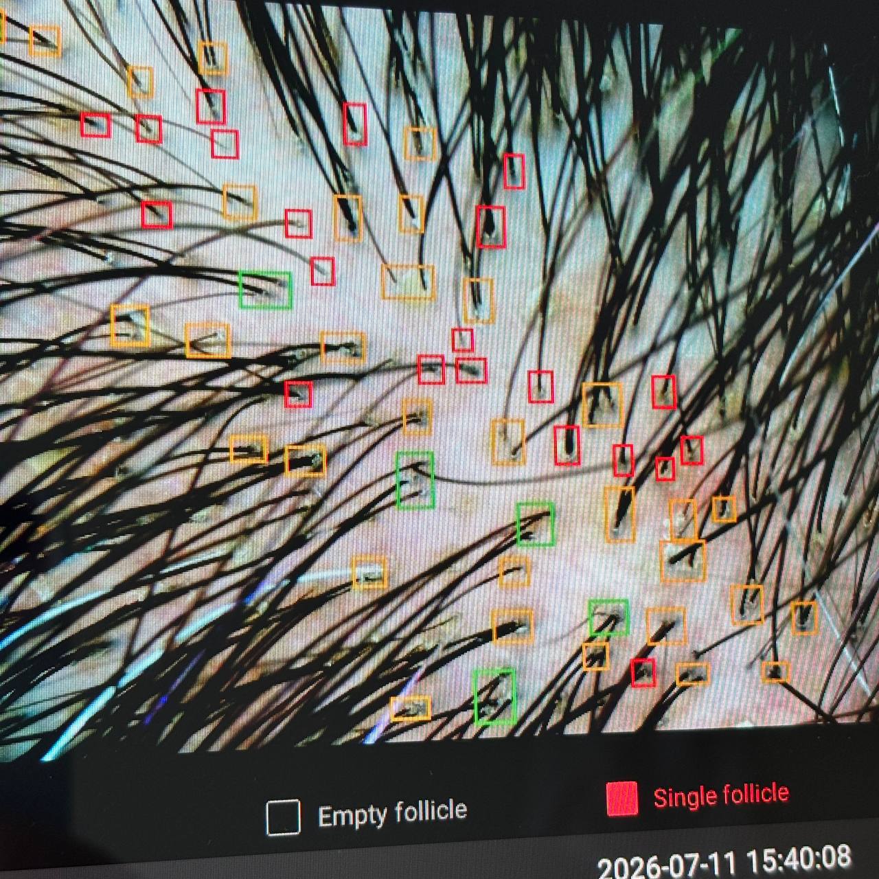 Professional scalp analysis screen